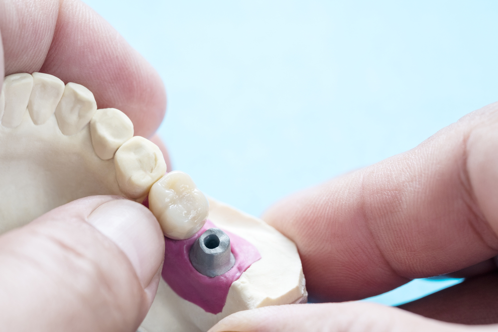 Implant dentaire